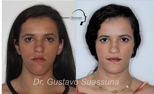 RECUO MAXILO-MANDIBULAR - CLINICA DA FACE