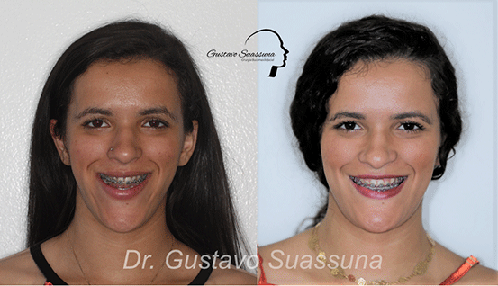 Excesso mandibular - Deficiência maxilar - Classe III - Dra