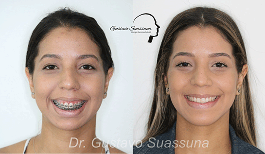 Cirurgia de mandíbula e maxilar - Consulta Ideal