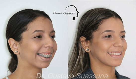 RECUO MAXILO-MANDIBULAR - CLINICA DA FACE