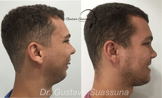 Clase II o Retrognatia Mandibular» Cirugía Ortognática - Instituto