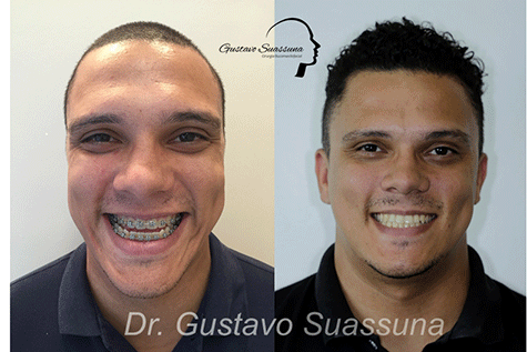 Cirurgia ortognática: antes e depois da cirurgia maxilar