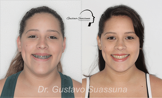 Excesso mandibular - Deficiência maxilar - Classe III - Dra